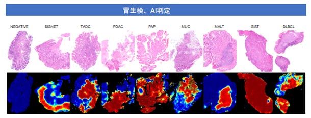 本AIによる胃生検の判定イメージ。上段：デジタル病理画像、下段：AI判定。陽性は赤、陰性は青で表示される。